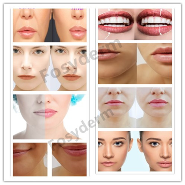 Hyaluronic Acid Injectable Dermal Filler 1ml 2ml For Lips Augmentation