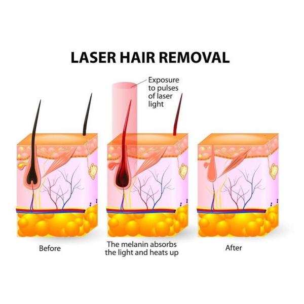 1200w Diode Laser Hair Removal Machine Salon 1-200J/CM2 Multifunction Beauty Machine