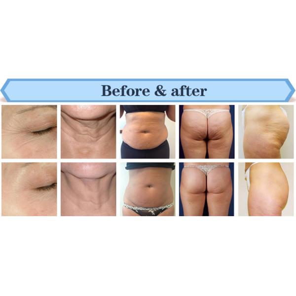 Popular beauty device about Tripollar RF ultrasonic cavitation vacuum massage