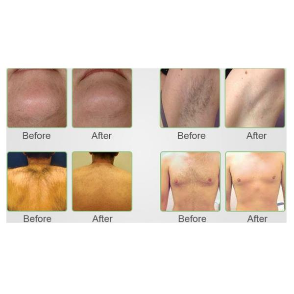 OEM Lady 808nm Laser Hair Removal Machine With Cooling 5-400ms