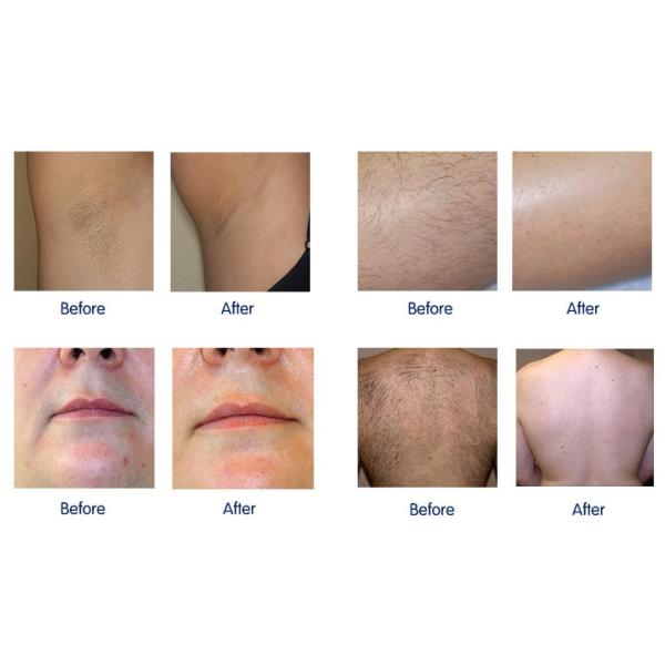 1200w Diode Laser Hair Removal Machine Salon 1-200J/CM2 Multifunction Beauty Machine