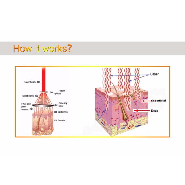 Customizing Commercial Co2 Fractional Laser Machine Skin Resurfacing