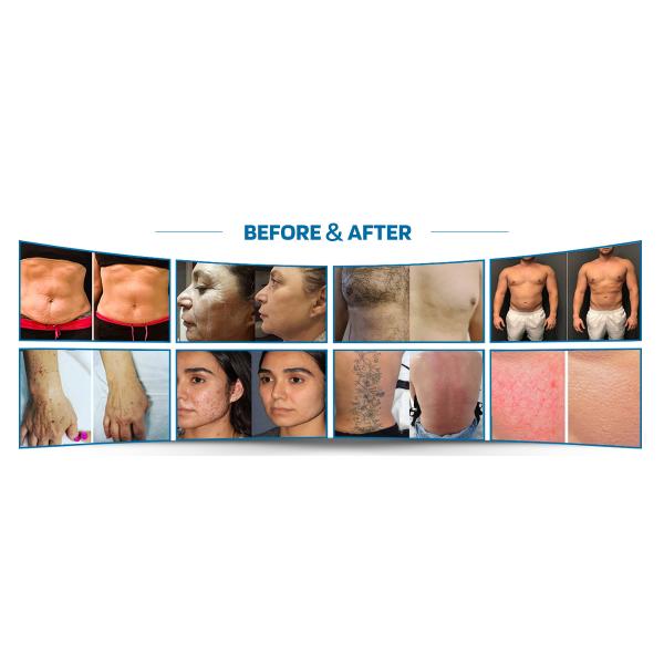 High Power ND:YAG Laser, Solid State Laser Device, Tattoo Removal Machine, Birthmark Removal Laser, Pigment Treatment Equipment, Carbon Peeling Laser System, Pore Shrinking Device, Eyebrow Cleaning Laser, Multi Wavelength Laser Machine, Adjustable Frequency Laser