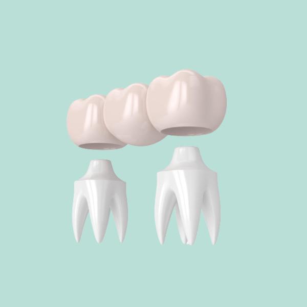 Healthy Dental Crown Bridge High Strength And Make The Smile More Beautiful