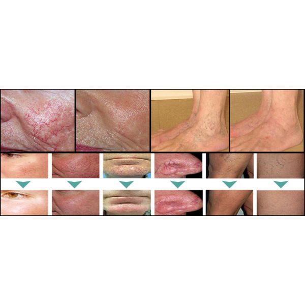 Spider vein laser removal Laser varicose vein removal treatment