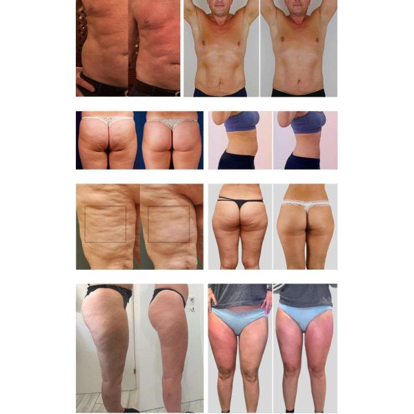 All In One 10D Slimming Roller Laser Equipment With Biolight Technology For Clinics And Spas