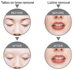 Long Pulsed 1064 ND YAG Laser Machine For Hair Removal , Ruby Laser Tattoo Removal Machine