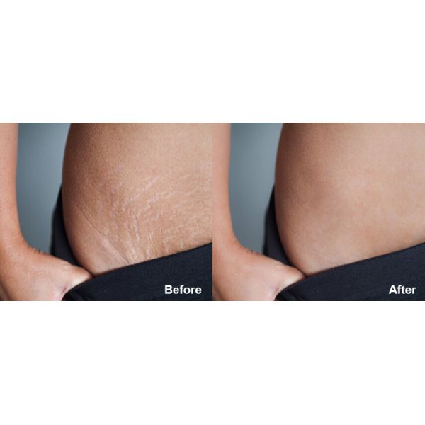 Cold Hammer Tecar RF Machine Radio Frequency Diathermy Face Lift Machine