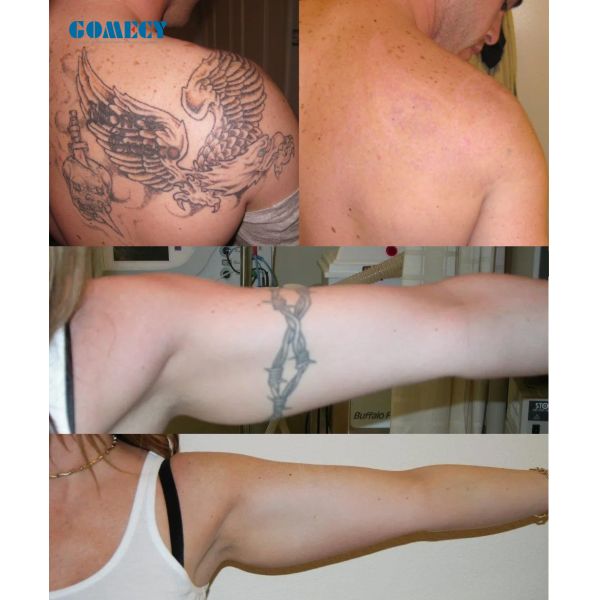 1-10Hz Laser Pigmentation Machine 2000W With LCD Touch Screen