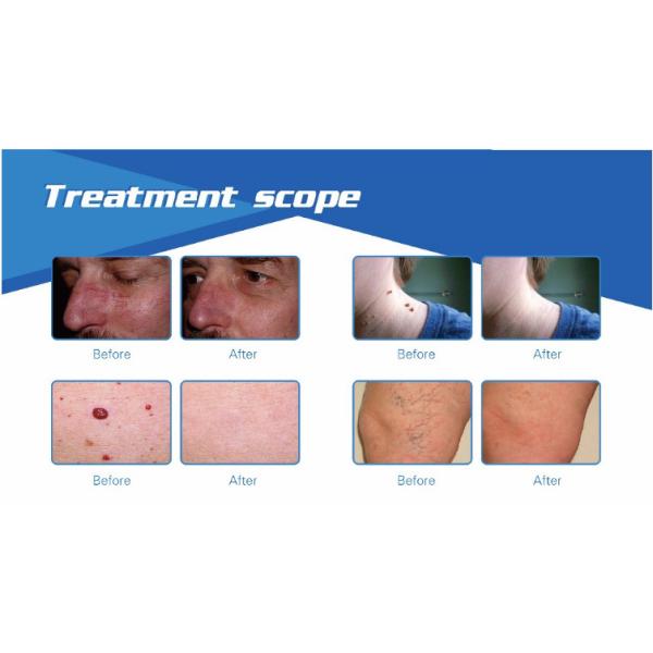 Fastest delivery time FDA approved portable diode laser 980nm spider vein vascular removal equipment