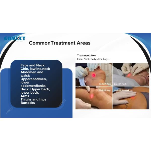 Face Lifting 980nm 1470 635 Laser Endo Neck Tighten Minimally Invasive Body Lipolysis Diode Laser Therapy Machine