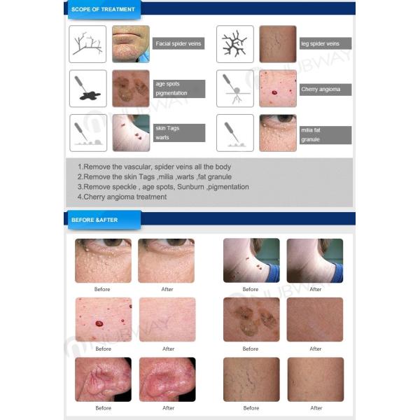 NUBWAY CE Certification 30w 980 nm diode laser spider vein removal machine