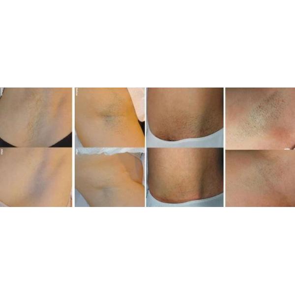 Compact and Efficient Portable Diode Laser Hair Removal Device for Professional Clinics