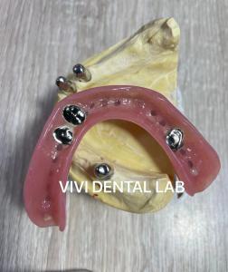 China Ni Be Free Dental Lab Crowns Telescopic Secondary Primary Teeth Crowns on sale