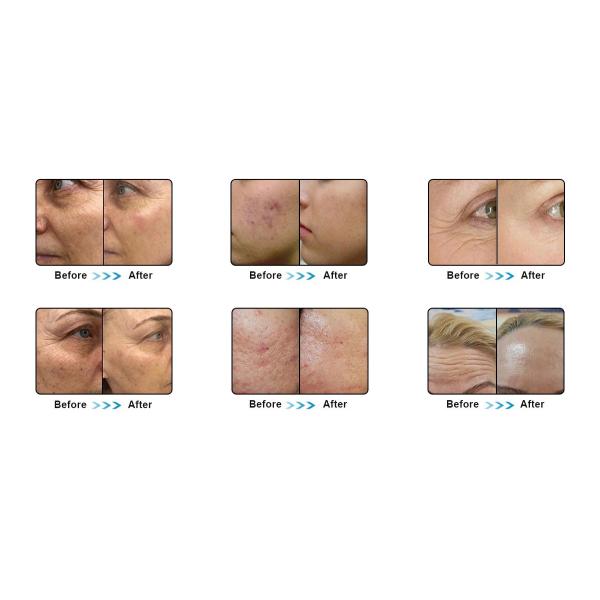 Professional vertical radio frequency microneedling Remove Stretch marks rf skin tightening machine