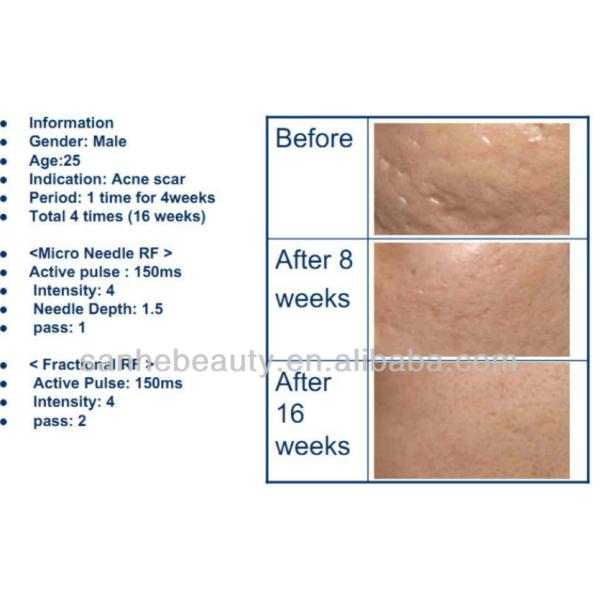 Portable face contour Micro needle rf fractional machine