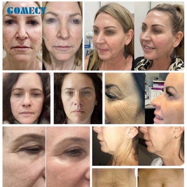 Professional 3-in-1 RF Microneedle Machine Morpheus8 Face Lifting Skin Tightening Device