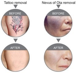 Long Pulsed 1064 ND YAG Laser Machine For Hair Removal , Ruby Laser Tattoo Removal Machine