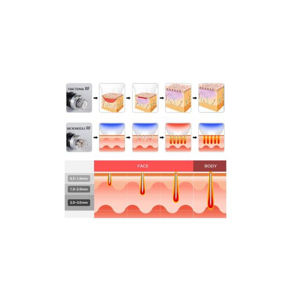 Professional vertical radio frequency microneedling Remove Stretch marks rf skin tightening machine