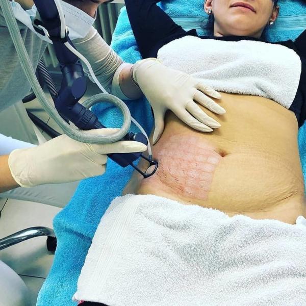 ExMatrix CO2 Fractional Laser Machine Vaginal Rejuvenation 110V TGA Approval