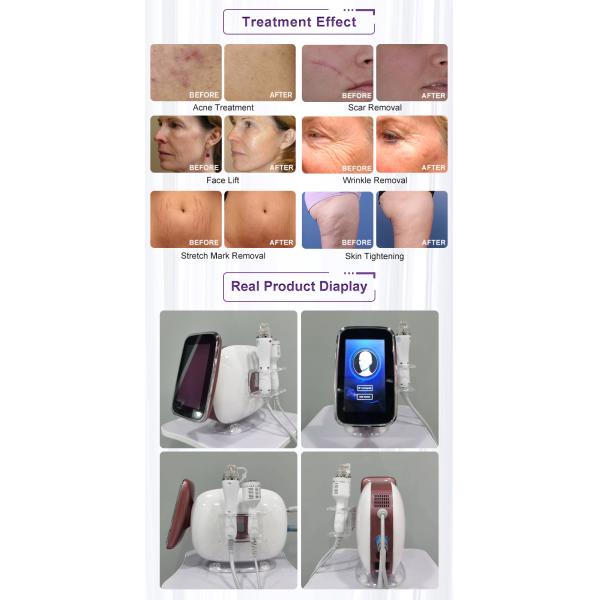 Gold Micro Needling With Radio Frequency Fractional Portable Rf Microneedling Machine For Face Beauty Device