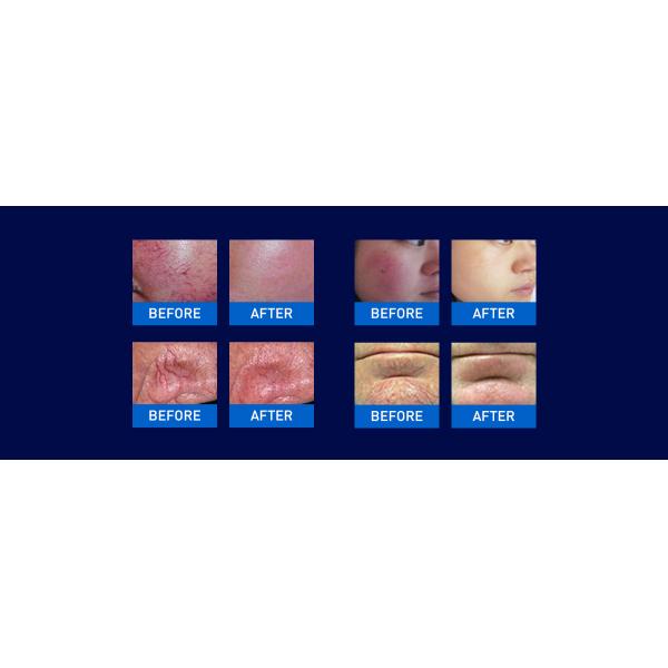 980 nm blood vascular cleaning vascular removal laser beauty device
