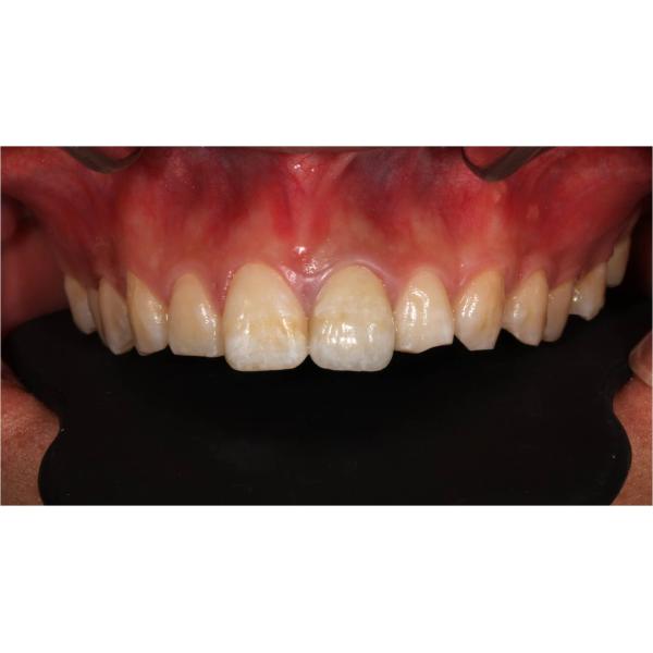 D98 Open System Zirconia Blocks Upcera 4D Explore