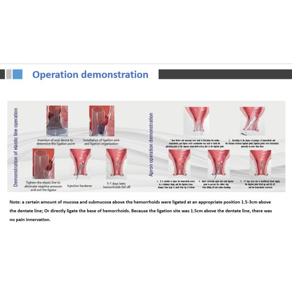 Surgical Anorectal Ligator Medical Disposable Stapler Data Visualization
