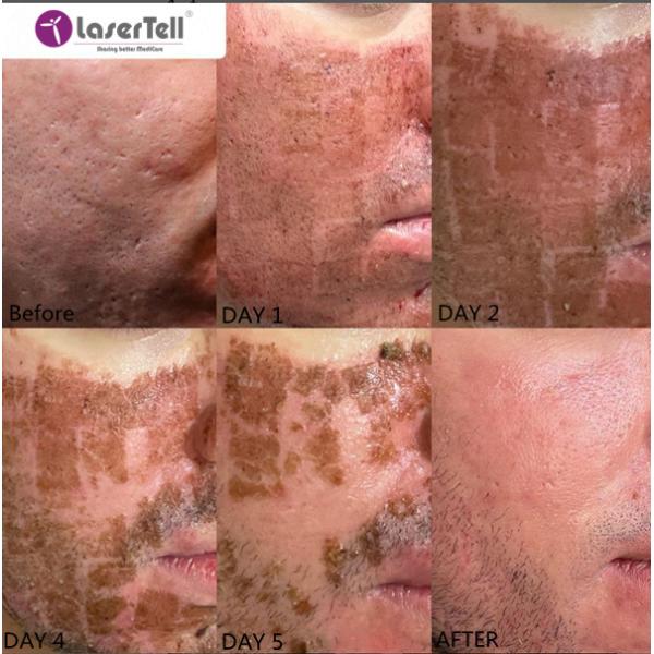Customizing Commercial Co2 Fractional Laser Machine Skin Resurfacing