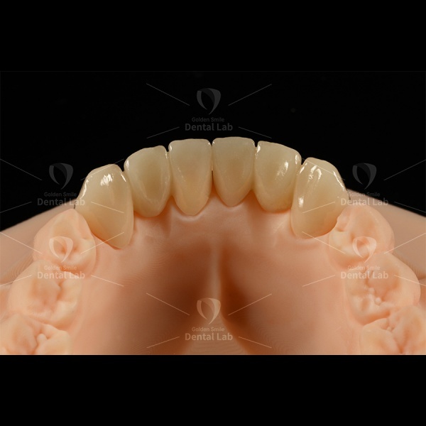 E Max Bridge Emax Laminate Veneers Lithium Disilicate Glass Ceramic Material