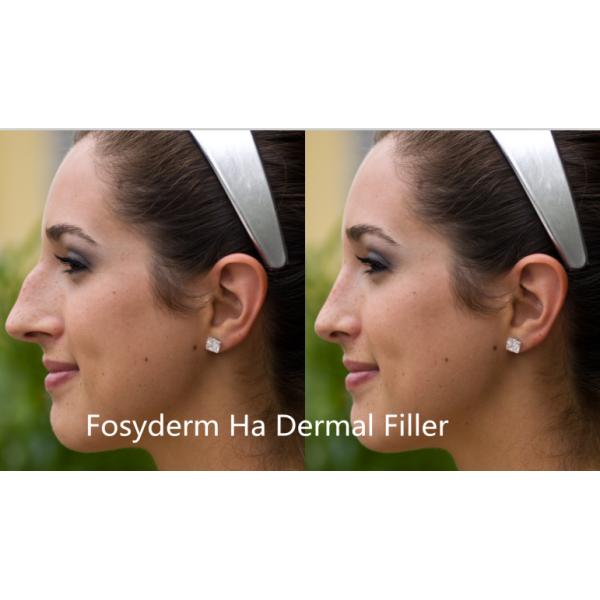 2ml Deep Lines Cross Linked Dermal Filler For Nose Reshaping Natural Looking