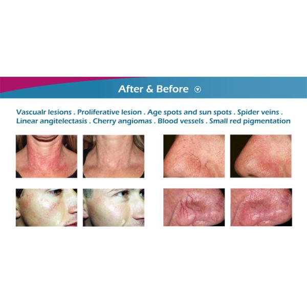 Newest high quality portable 8.4 inch screen 60w 980nm diode laser vascular removal machine for beauty salon use