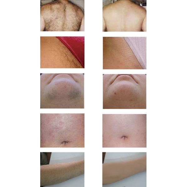Promotion only this month manufacture 808 diode laser hair removal machine