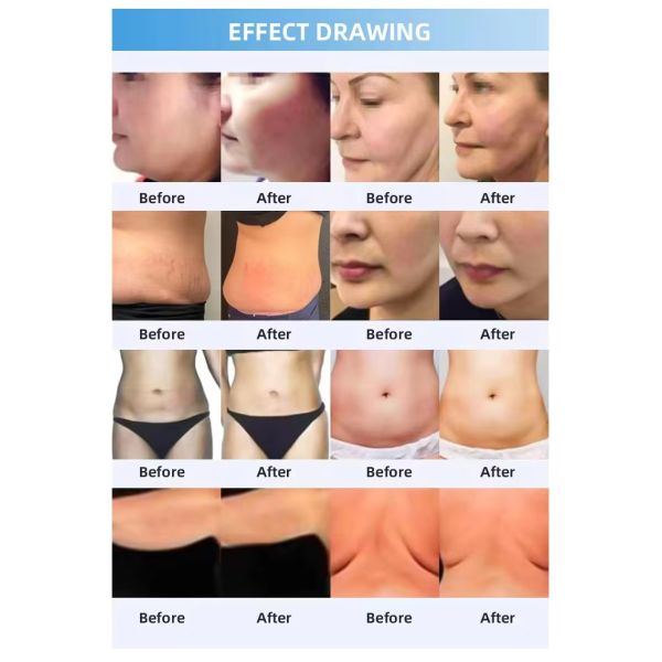 Cryotherapy Slimming Machine Body Fat Freezing Skin Tightening Thermal Shock Beauty Device