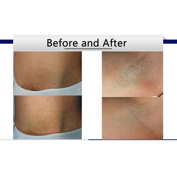4 In 1 Diode Laser Hair Removal Machine Very Easy To Operate Highly Safety