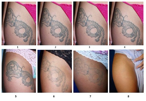 Permanent 532 nm / 1064 nm ND YAG Laser Machine , Laser Q Switch Tattoo Removal