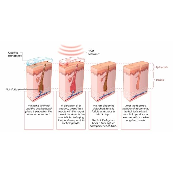 Promotion only this month manufacture 808 diode laser hair removal machine