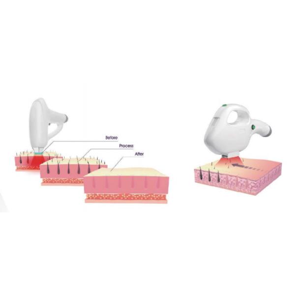 808nm Commercial ipl diode Laser Hair Removal Machine With Big Spot Size 13×13mm2