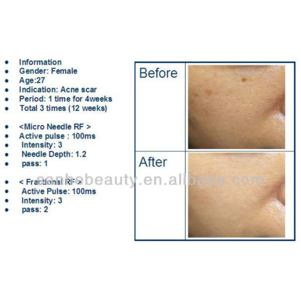 Portable face contour Micro needle rf fractional machine