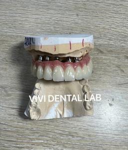 China Total Implant PFM Bridge China Dental Lab on sale
