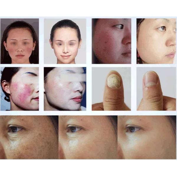 White Portable 980nm Diode Laser Machine Medical Nail Fungus Laser Machine