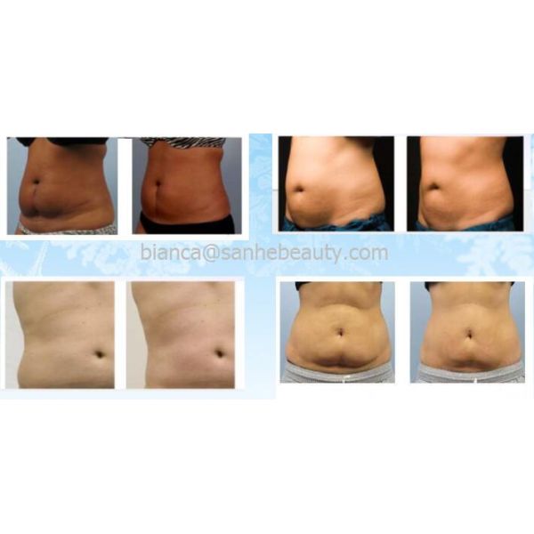Wholesales Portable Cryolipo Venus Freeze Machine