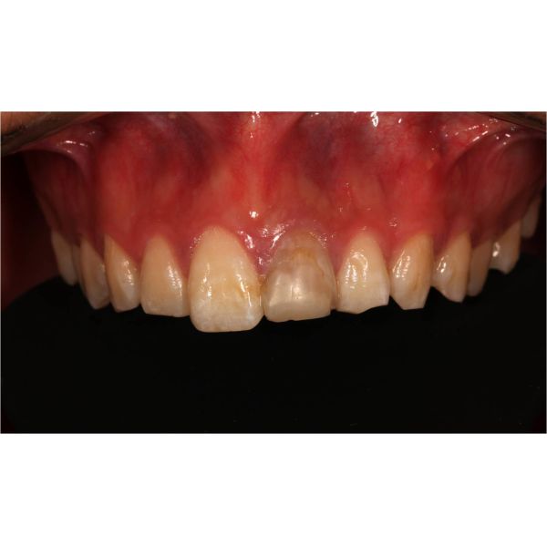 D98 Open System Zirconia Blocks Upcera 4D Explore