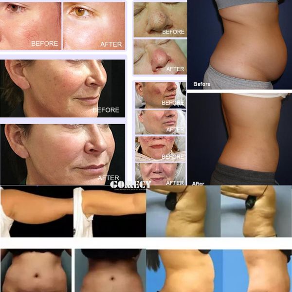 Face Lifting 980nm 1470 635 Laser Endo Neck Tighten Minimally Invasive Body Lipolysis Diode Laser Therapy Machine
