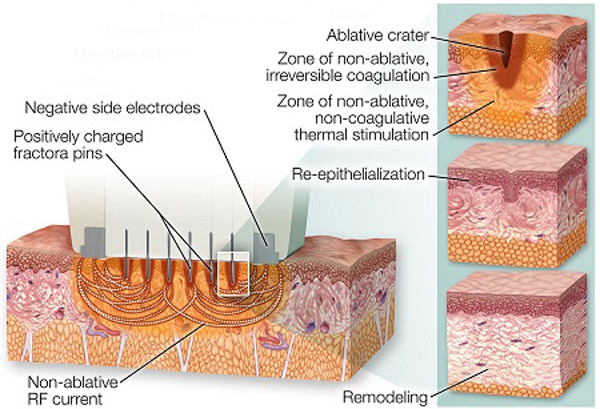 Skin maintenance microneedle nurse system fractional radiofrequency micro needling