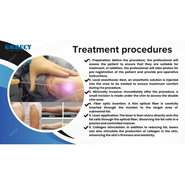 Face Lifting 980nm 1470 635 Laser Endo Neck Tighten Minimally Invasive Body Lipolysis Diode Laser Therapy Machine