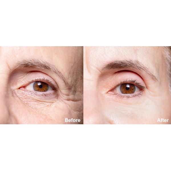 Cold Hammer Tecar RF Machine Radio Frequency Diathermy Face Lift Machine