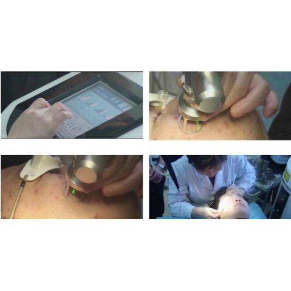 40W RF Tube Laser Generator Vaginal Tightening Laser CO2 Fractional machine