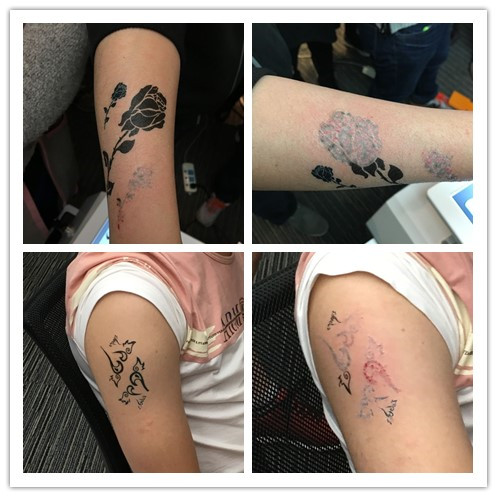 Hot sale professional Q-switch nd yag laser tattoo removal machine
