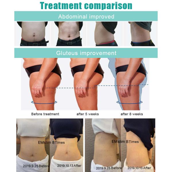 Air Cooling Body Sculpting Machine Hiemt Beautiful Muscle Machine